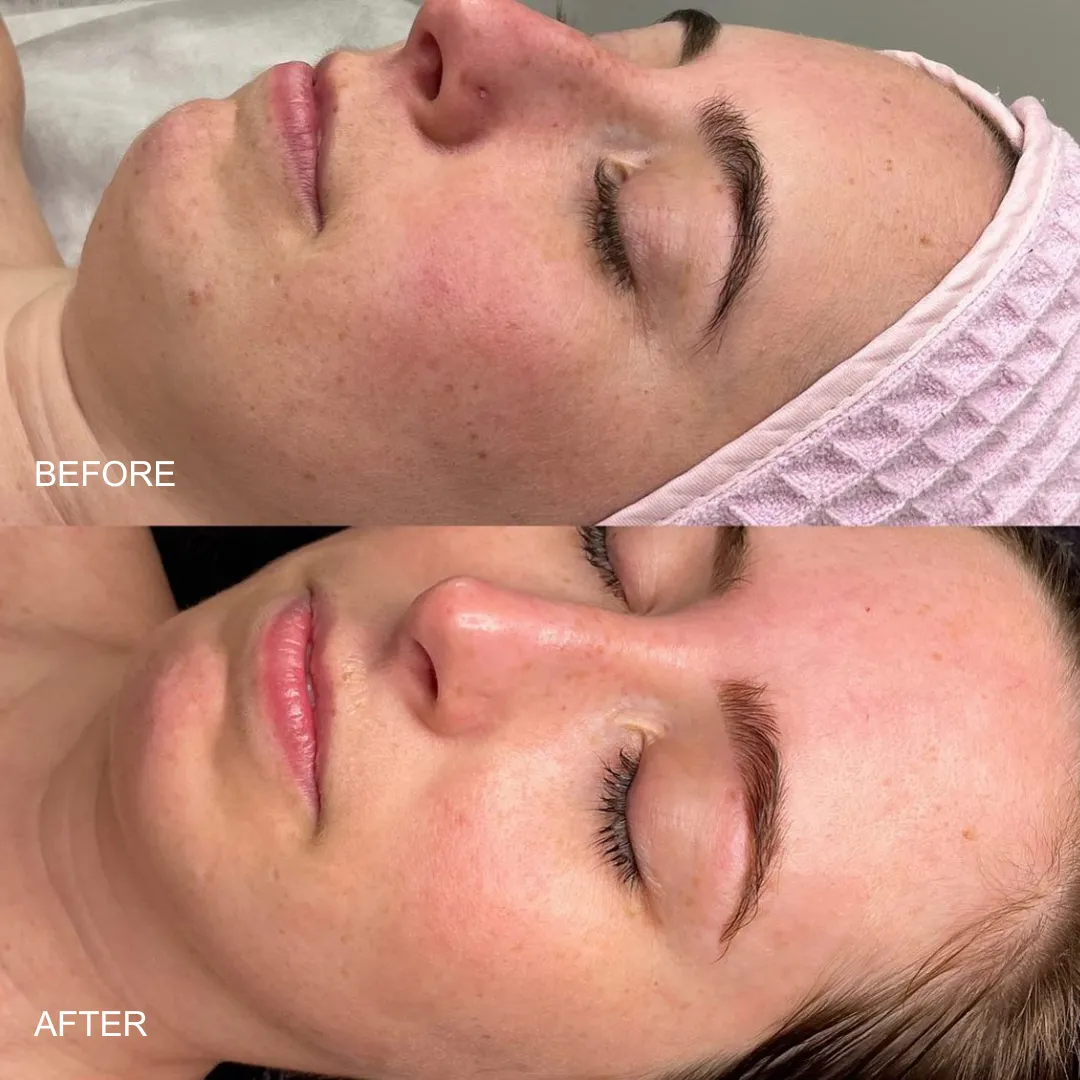 Skin Aura client before and after: significantly reduced dark spots